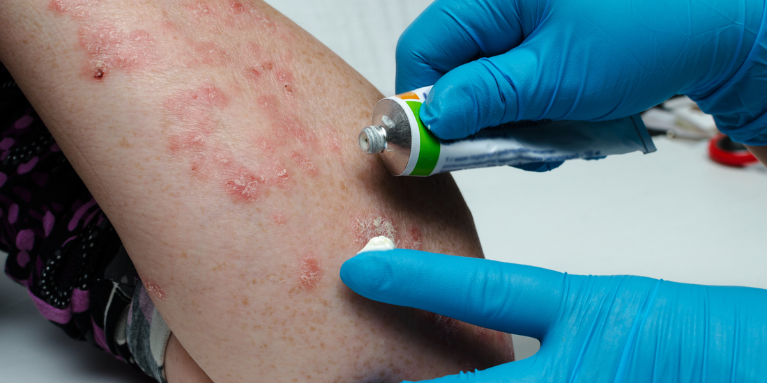 medicatie bij eczeem uitgelegd